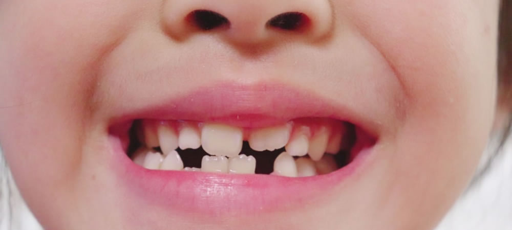 生え変わる乳歯の抜き方