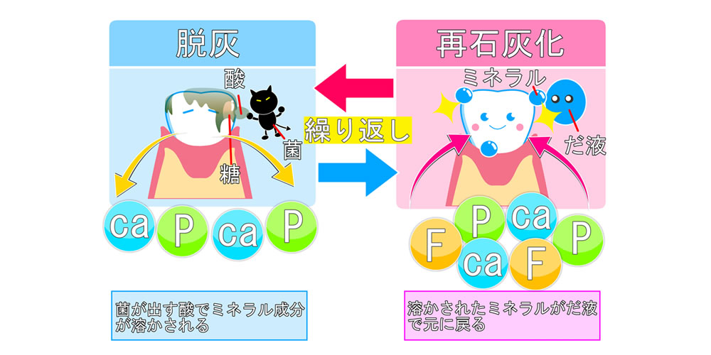 脱灰と歯の再石灰化