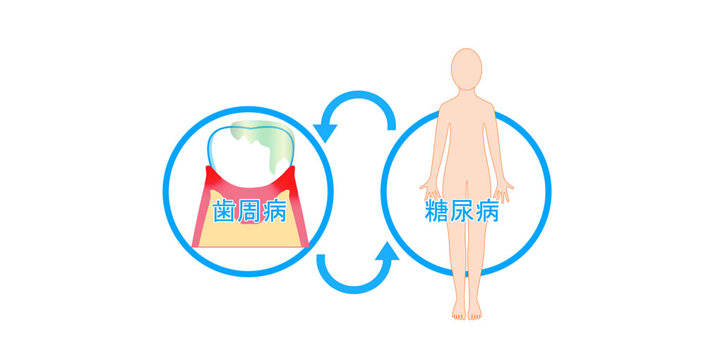 歯周病と糖尿病がお互いにリスクを高める原因とは？