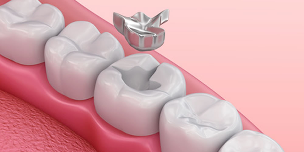 歯医者さんがおすすめしない銀歯のメリット・デメリット