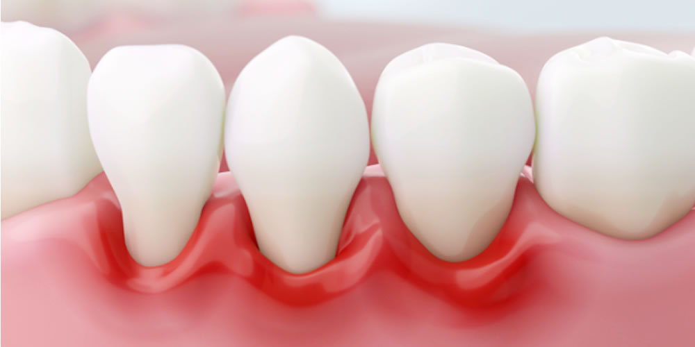 歯周病になりやすい人の特徴