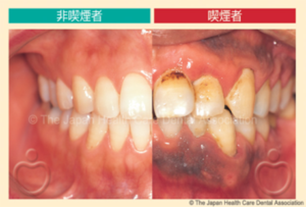 歯周病とたばこの関係