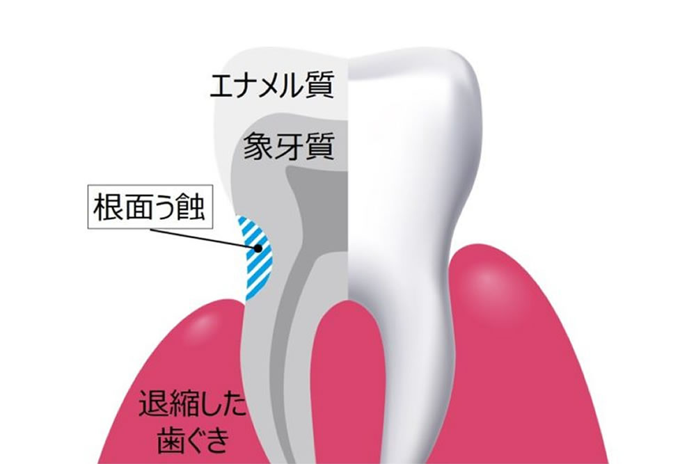 大人の虫歯「根面う蝕」