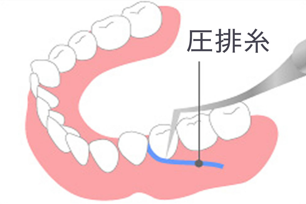 歯肉圧排