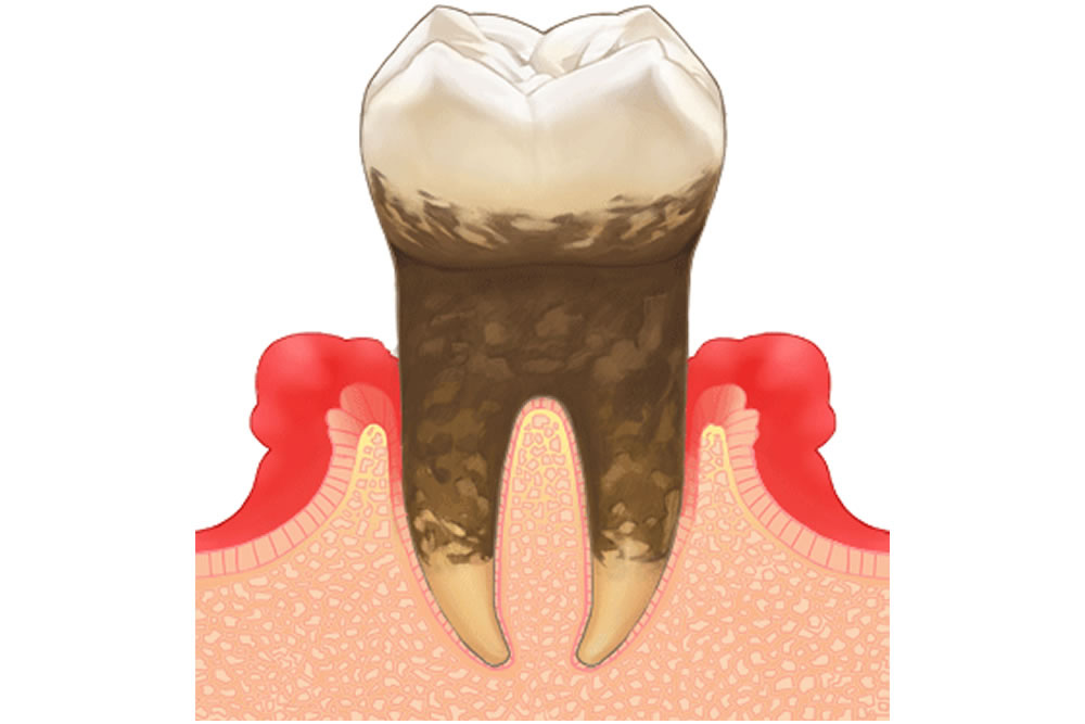 歯周病チェック