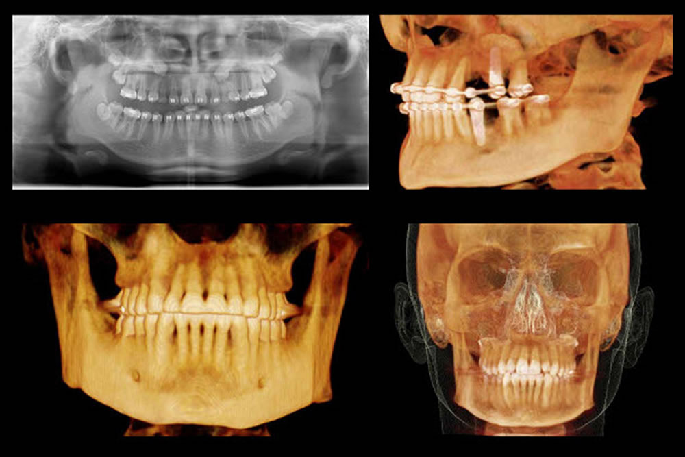 歯科用CT